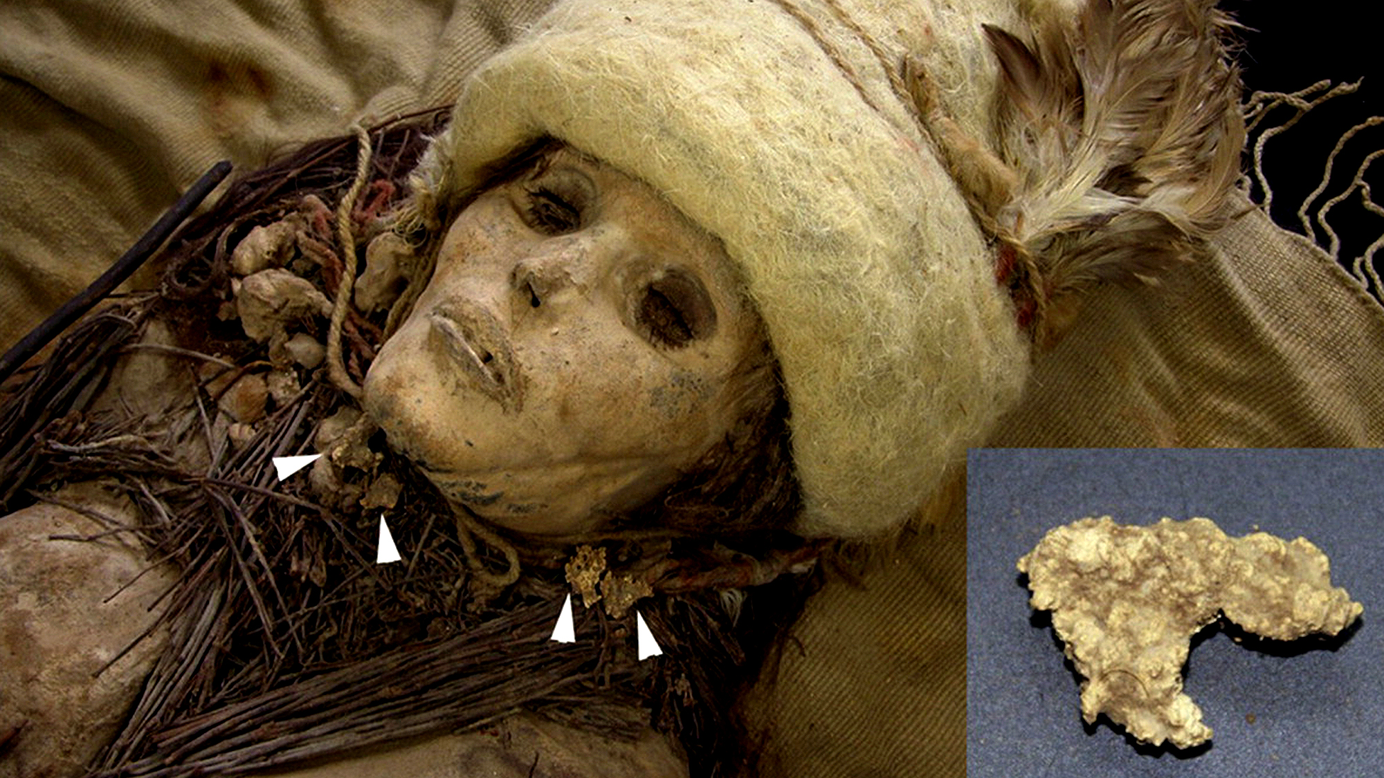 A mummy from an Early Bronze Age cemetery of Xiaohe (1980–1450 BC) in Xinjiang, China and very old cheese.