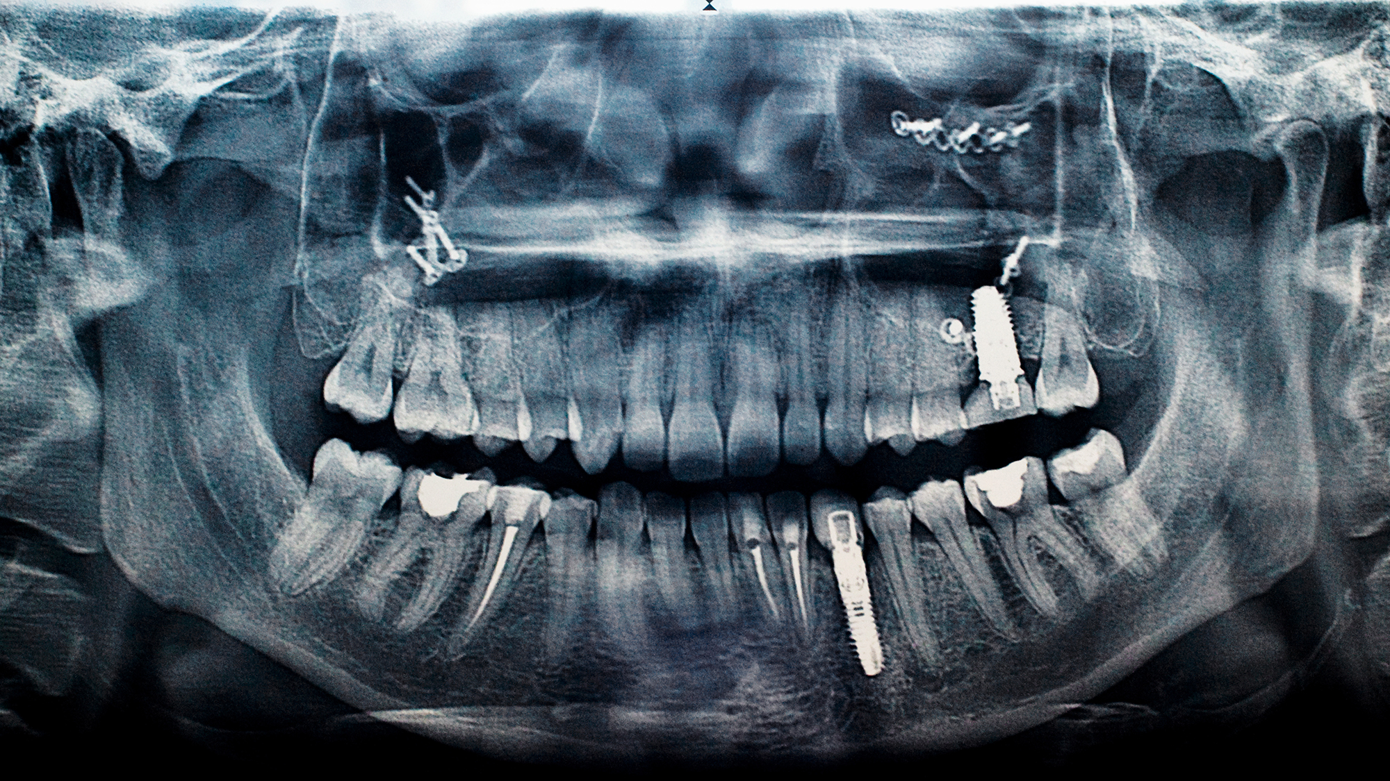 Dental implants have been used to replace damaged or missing teeth for decades. They generally consist of a metal anchor screwed into the bone, then capped with a prosthetic tooth, commonly made of porcelain.