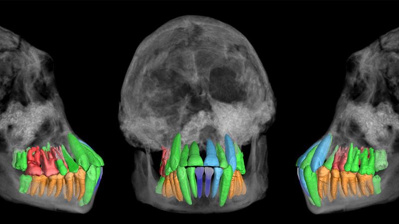 x-ray scans of early human skulls. the teeth are colored red, green, orange, blue, and purple to show the differences among them