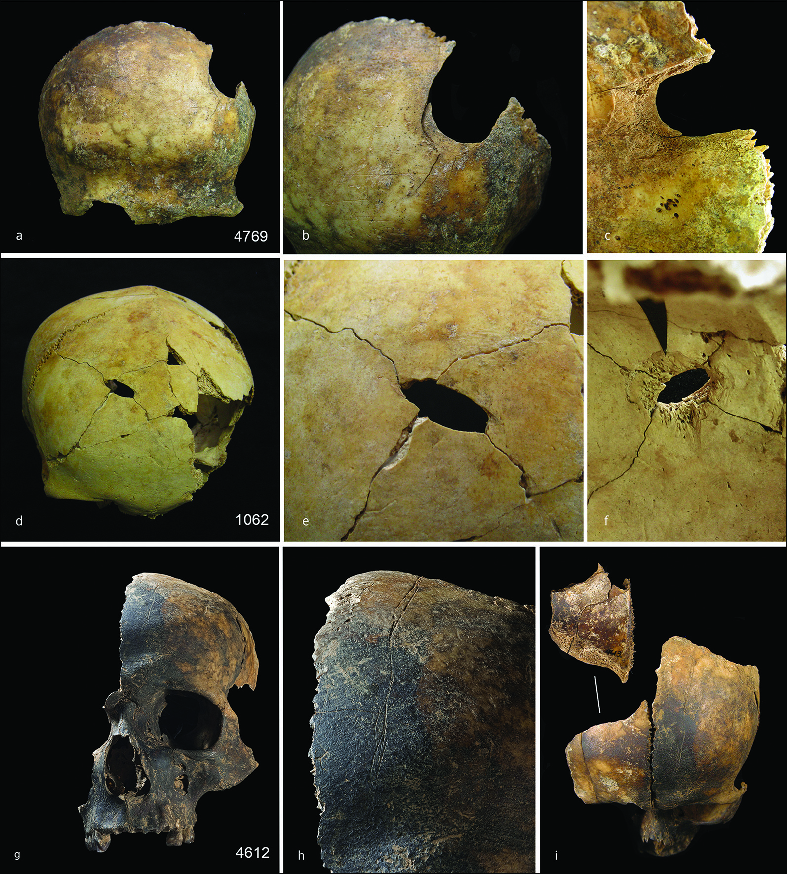 Examples of cranial trauma. Top) perimortem injury to the left posterior of the frontal bone (a), cutmarks can also be seen on the frontal bone (b) and patinated bevel of the internal cranial surface is apparent around the injury (c); middle) cranium with a perforating injury to mid-frontal bone (d), a closer view shows radiating fracture lines (e) and the internal view shows patinated bevel (f ); bottom) adult cranium (g), close inspection shows cutmarks running along the mid-frontal (h) and a perimortem blunt force fracture to the conjoining right frontal bone fragment (i) Images by Schulting et al. Antiquity, December 2024. CREDIT: Schulting et al. Antiquity, December 2024.