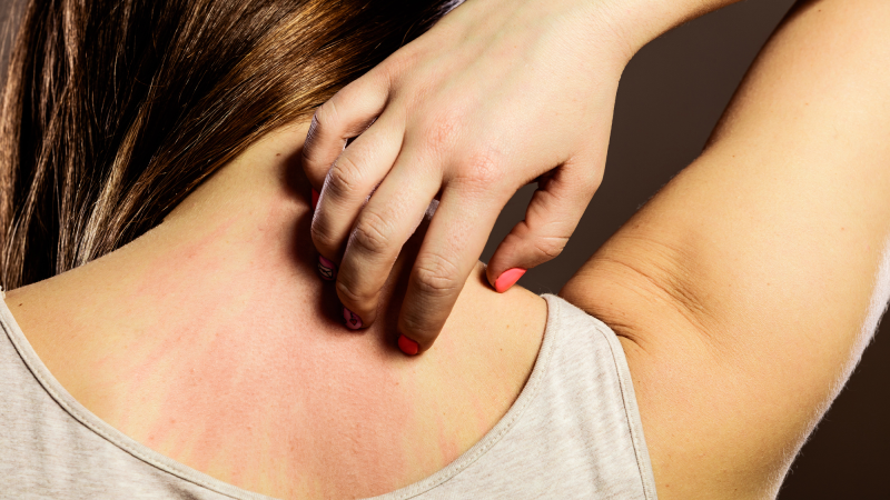 a woman reaches to scratch a red rash on her upper back