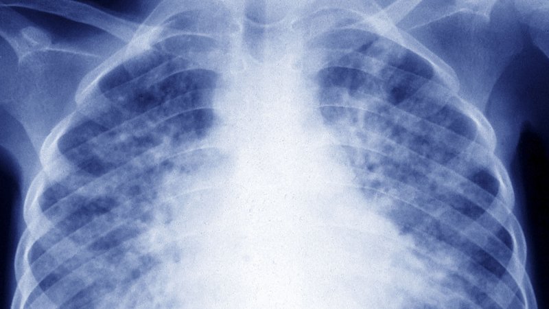 Pulmonary tuberculosis,spreading through the lungs.