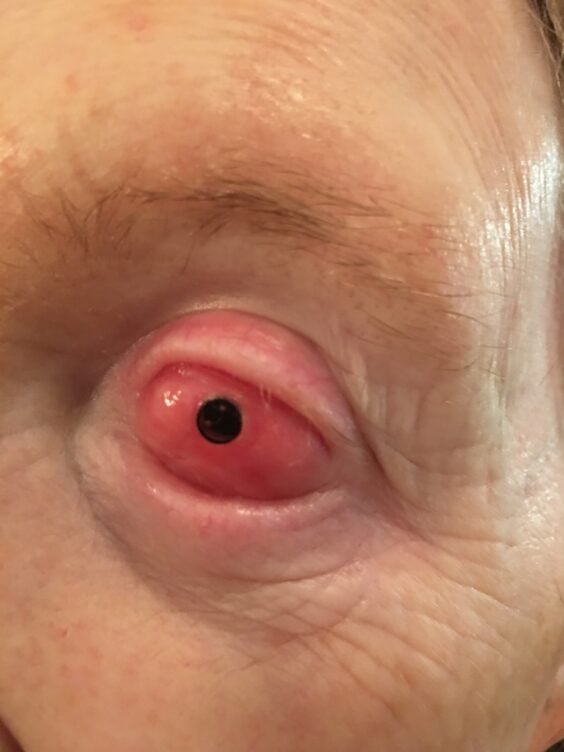 A patient’s eye after the tooth has been surgically implanted over the eyeball in “tooth-in-eye” surgery. Credit: Greg Moloney / Providence Health Care